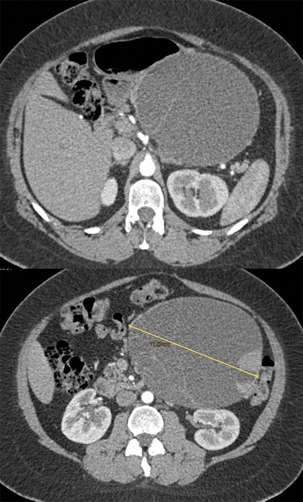 Mucinous Cystic Neoplasm (MCN) with High Grade Dysplasia