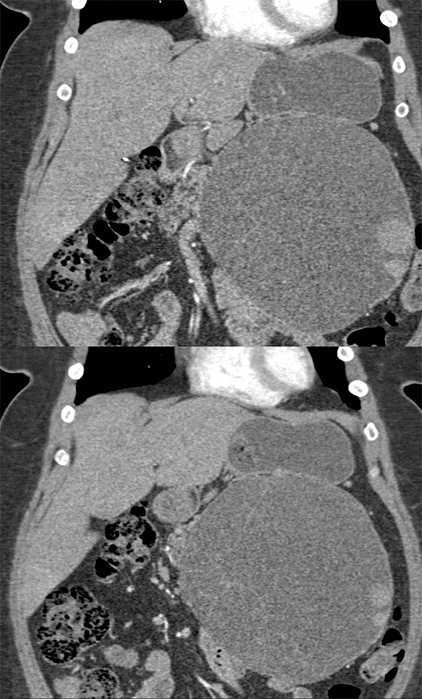 Mucinous Cystic Neoplasm