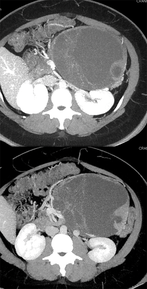 Mucinous Cystic Neoplasm