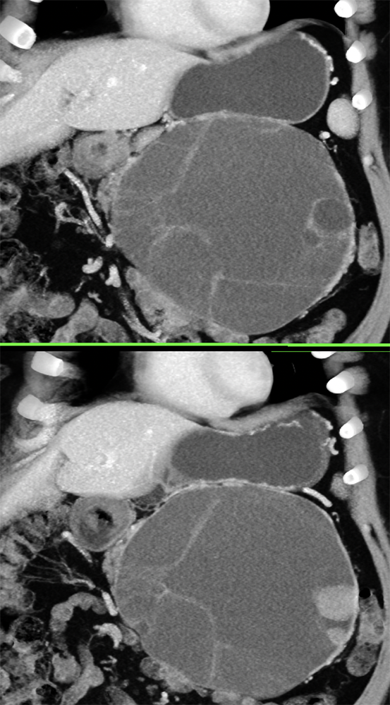 Mucinous Cystic Neoplasm