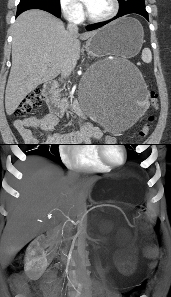 Mucinous Cystic Neoplasm