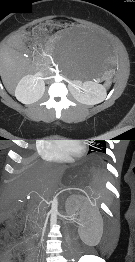 Mucinous Cystic Neoplasm