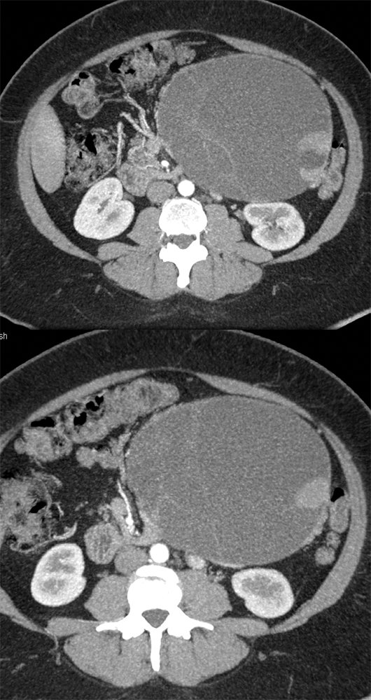 Mucinous Cystic Neoplasm