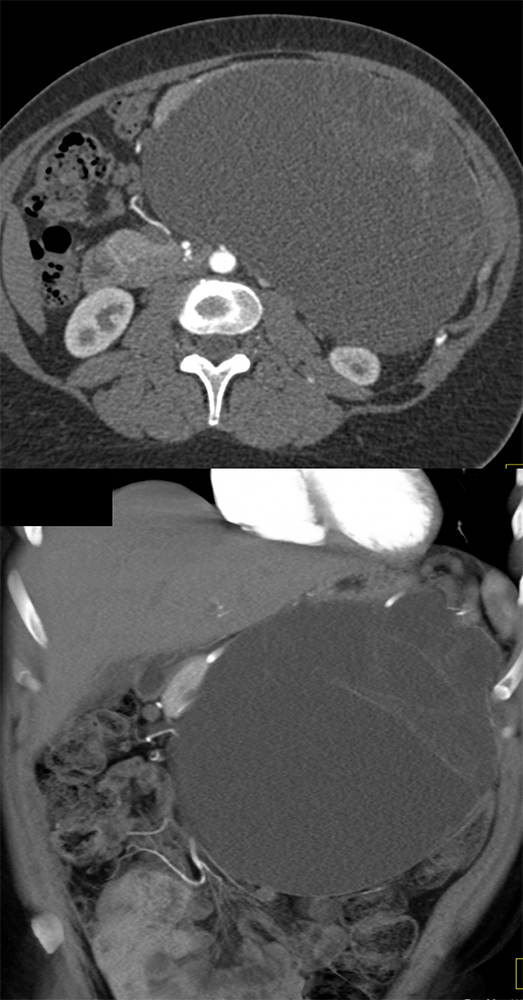 Abdominal Distension