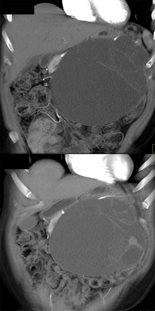 Mucinous Cystic Neoplasm