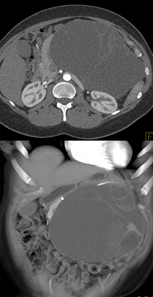 Mucinous Cystic Neoplasm