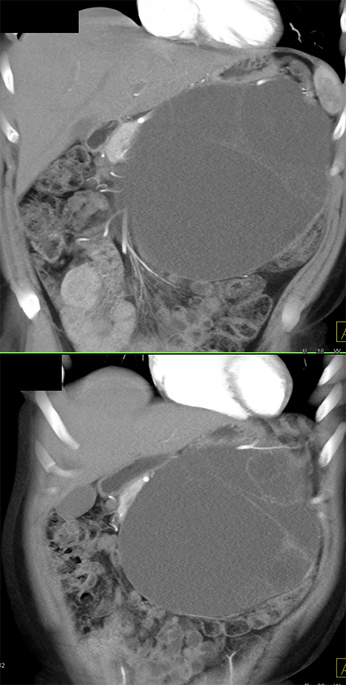 Mucinous Cystic Neoplasm