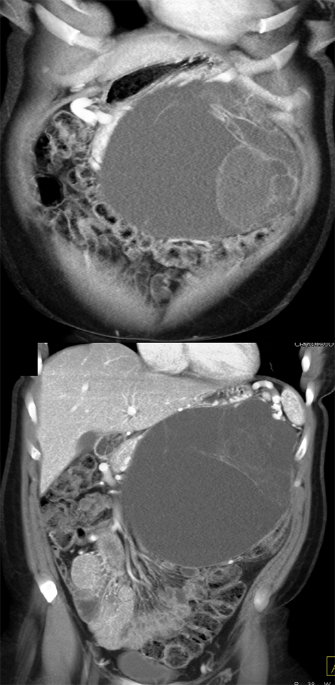 Mucinous Cystic Neoplasm