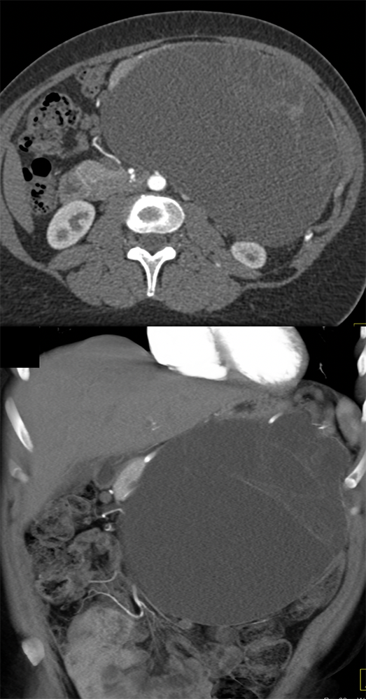 MCN with High Grade Dysplasia