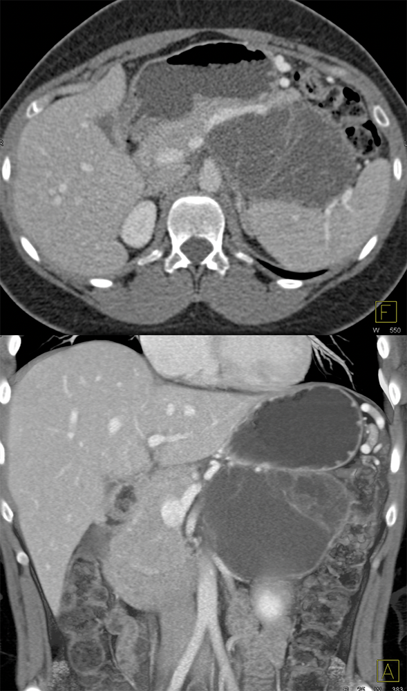 Mucinous Cystic Neoplasms