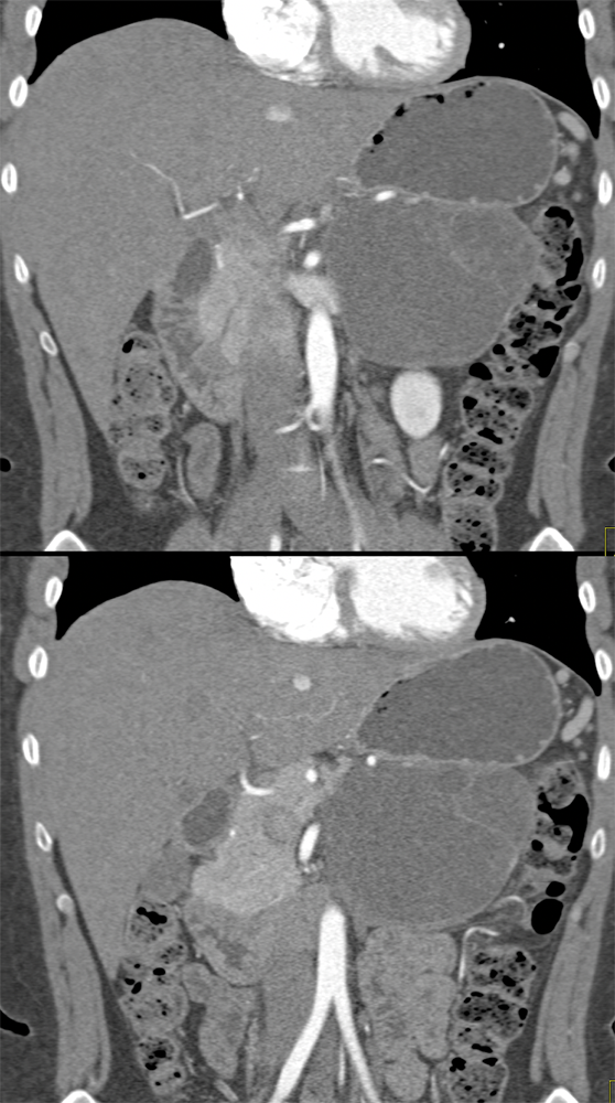 Mucinous Cystic Neoplasms