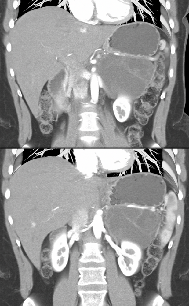 Mucinous Cystic Neoplasms