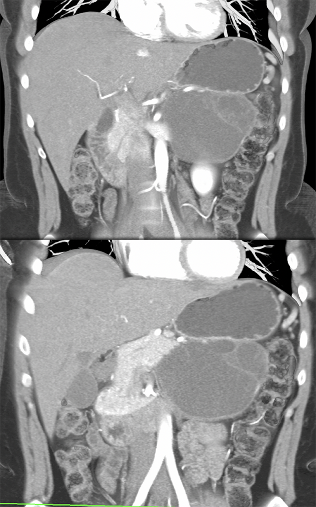 Mucinous Cystic Neoplasms