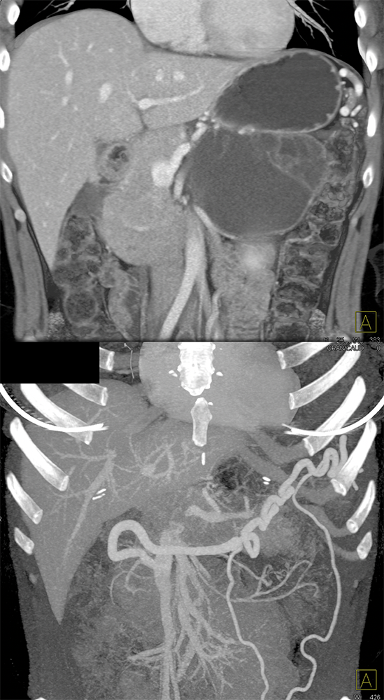 Mucinous Cystic Neoplasms