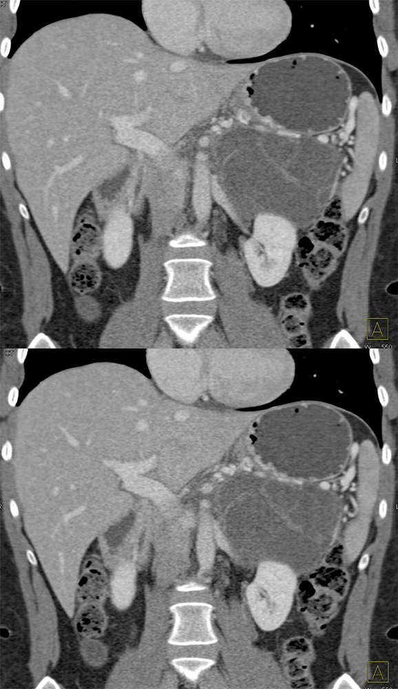 Mucinous Cystic Neoplasms