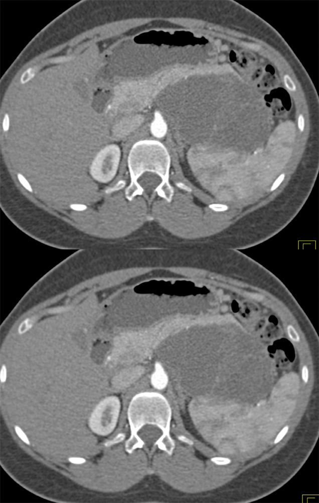 MCN with High Grade Dysplasia