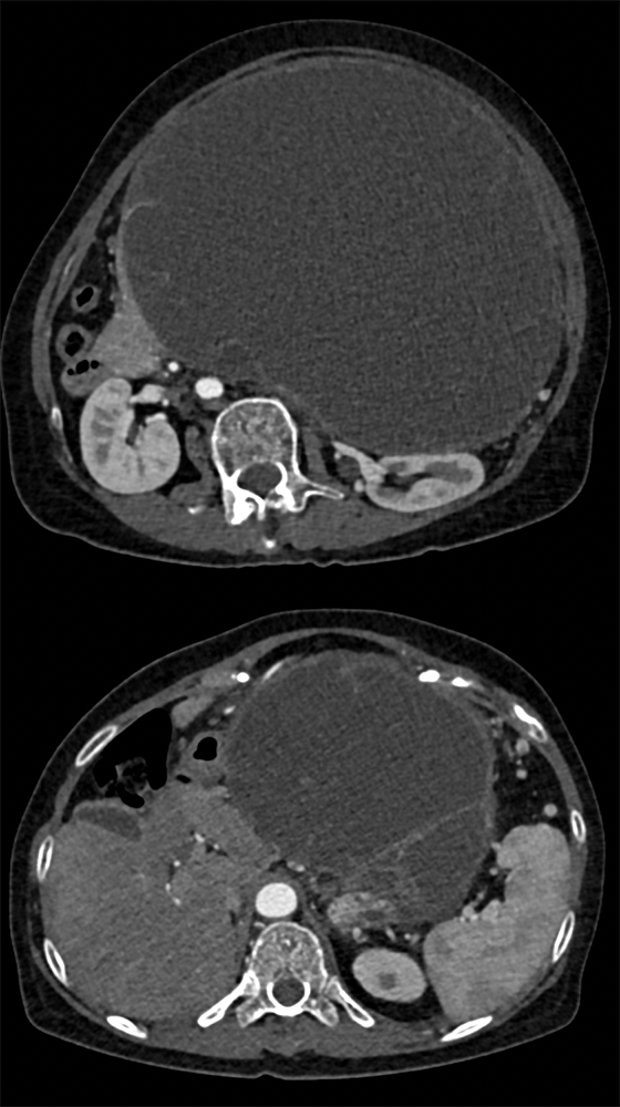 Abdominal Distension