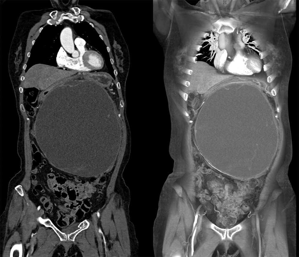 Mucinous Cystic Neoplasms