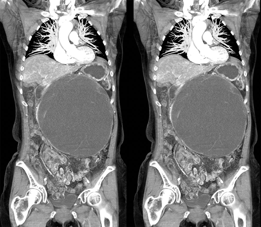 Mucinous Cystic Neoplasms