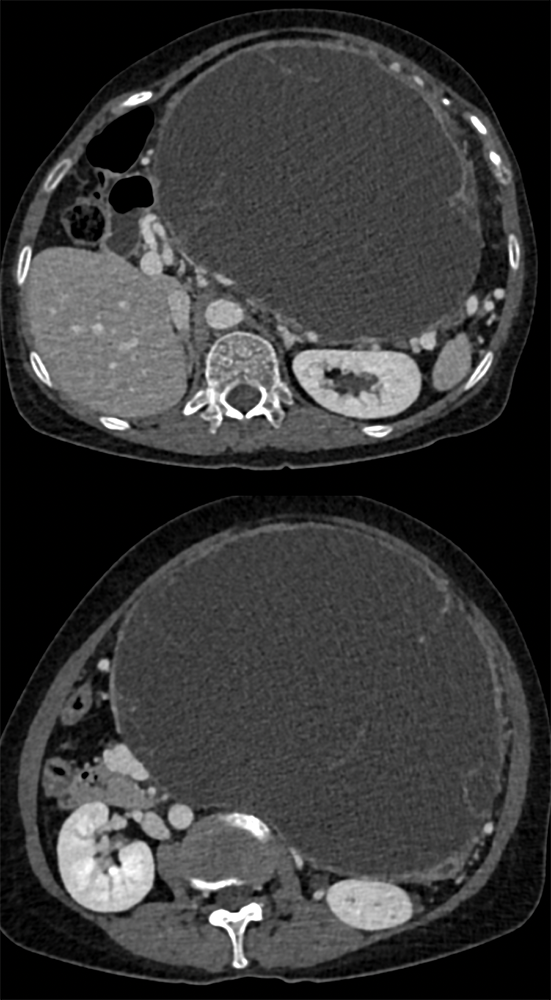 Mucinous Cystic Neoplasms