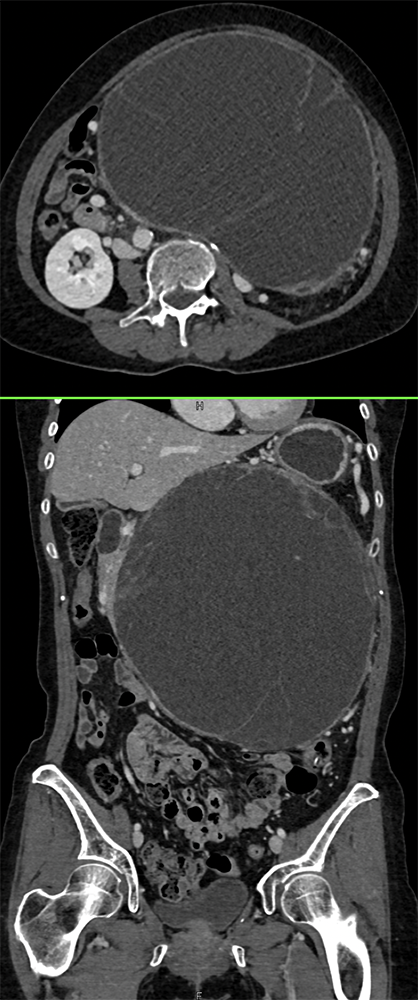 Mucinous Cystic Neoplasms