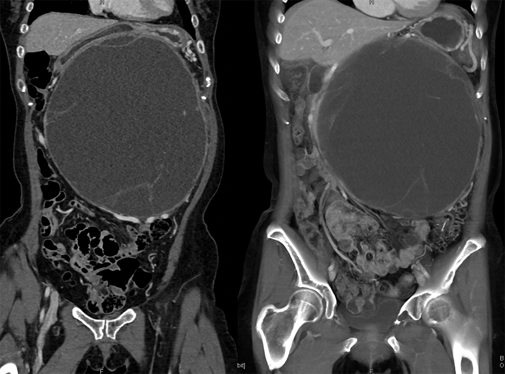 Mucinous Cystic Neoplasms