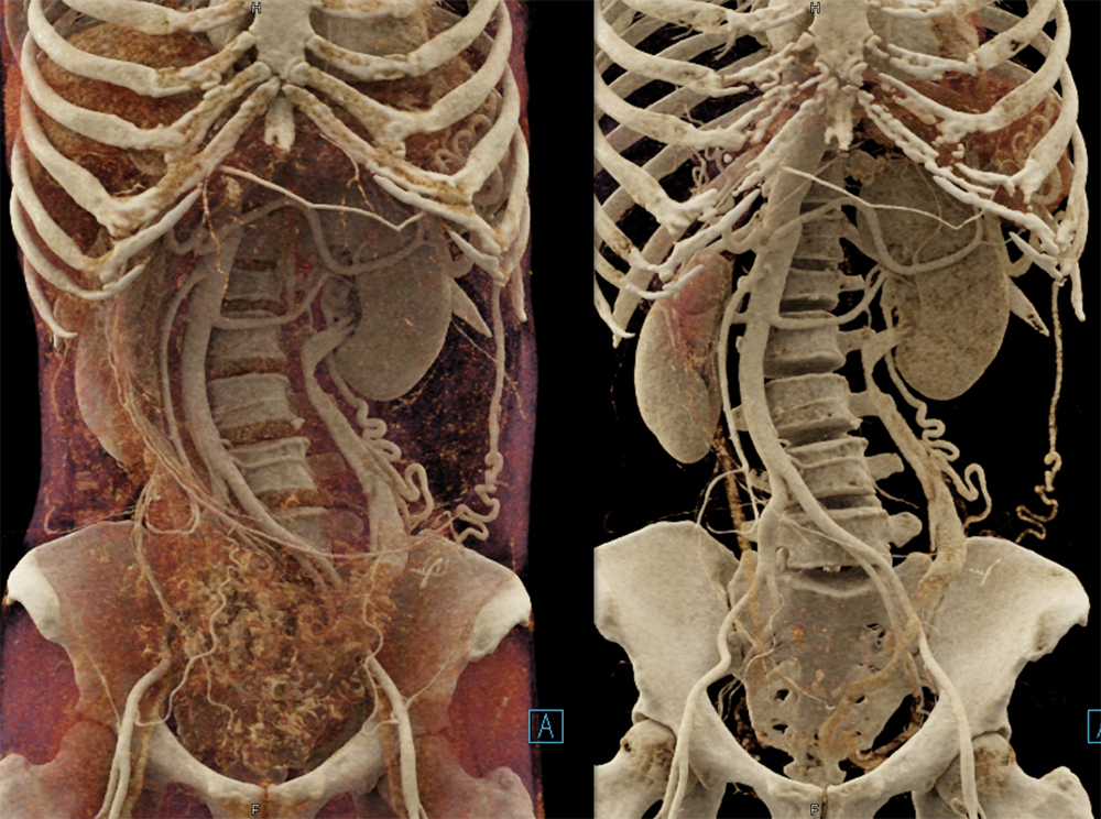 Mucinous Cystic Neoplasms