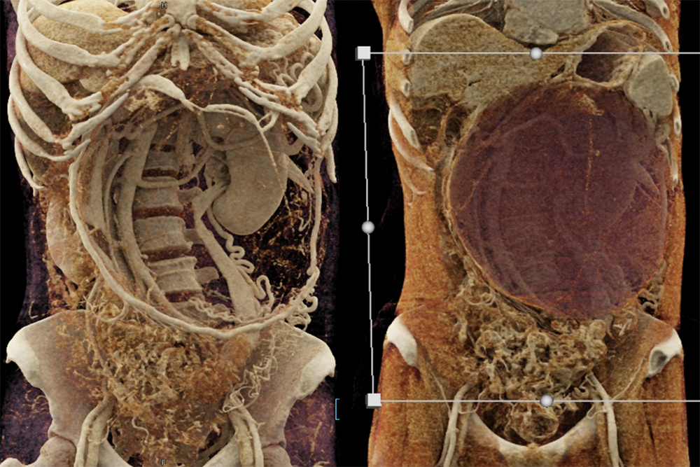 Mucinous Cystic Neoplasms