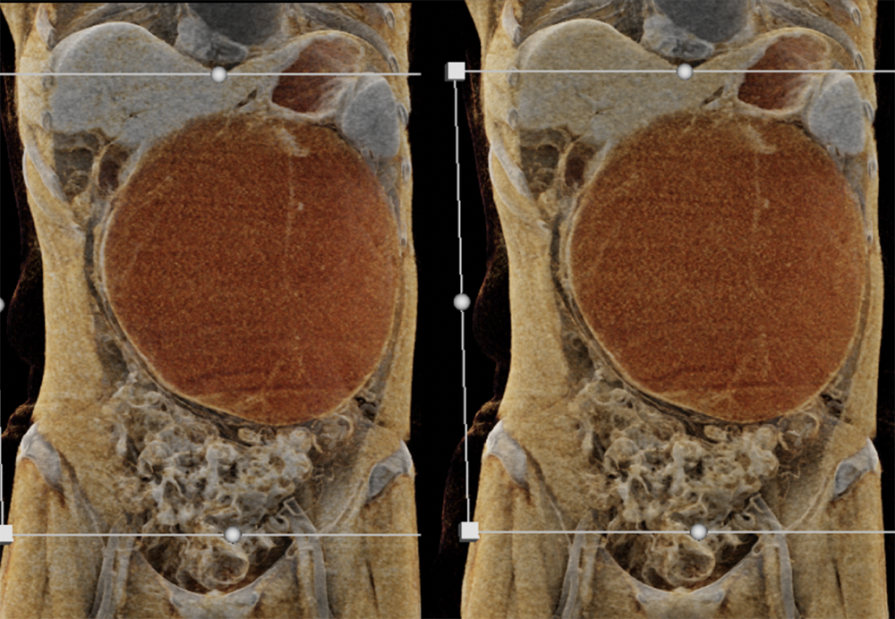 Mucinous Cystic Neoplasms