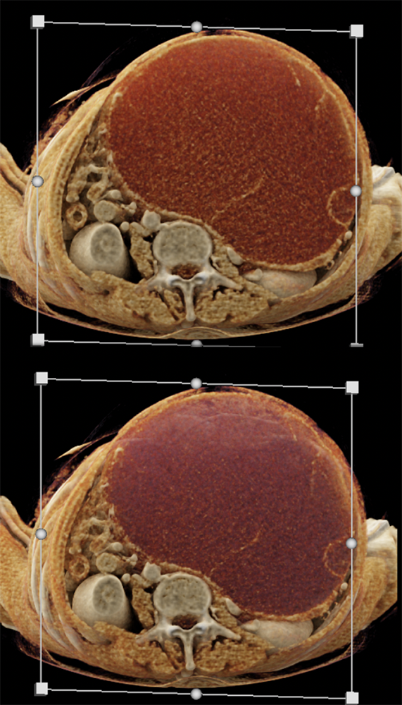 Mucinous Cystic Neoplasms