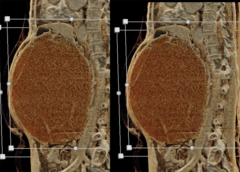 Mucinous Cystic Neoplasms