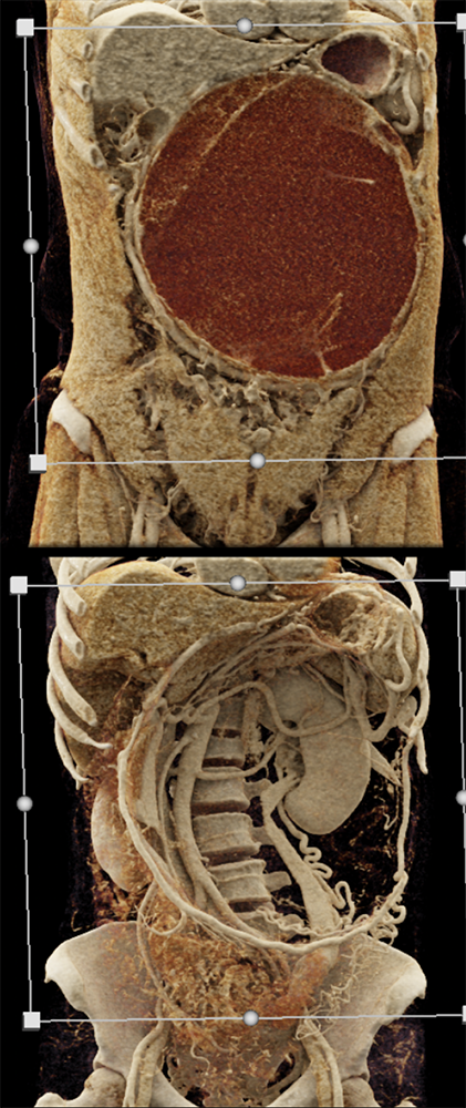 Mucinous Cystic Neoplasms