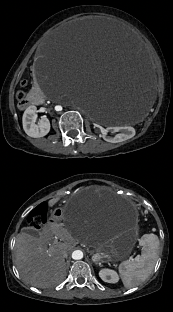 MCN with High Grade Dysplasia