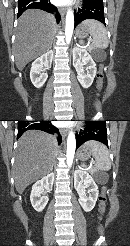 Mucinous Cystic Neoplasms