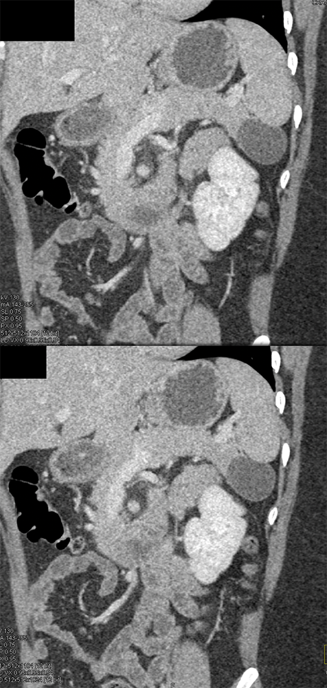 Mucinous Cystic Neoplasms