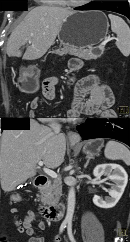 Mucinous Cystic Neoplasms