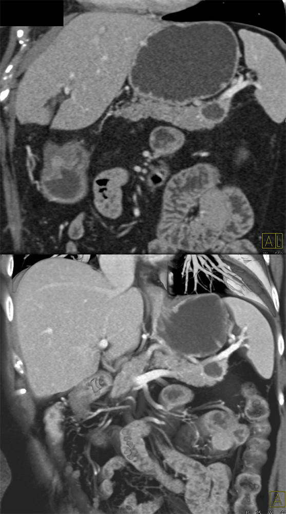 Mucinous Cystic Neoplasms