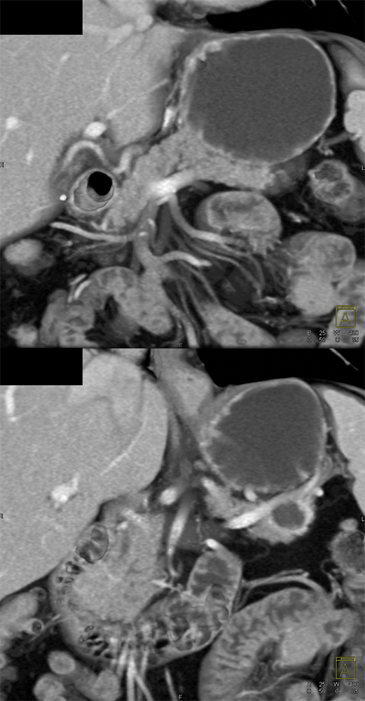 Mucinous Cystic Neoplasms