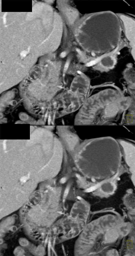 Mucinous Cystic Neoplasms