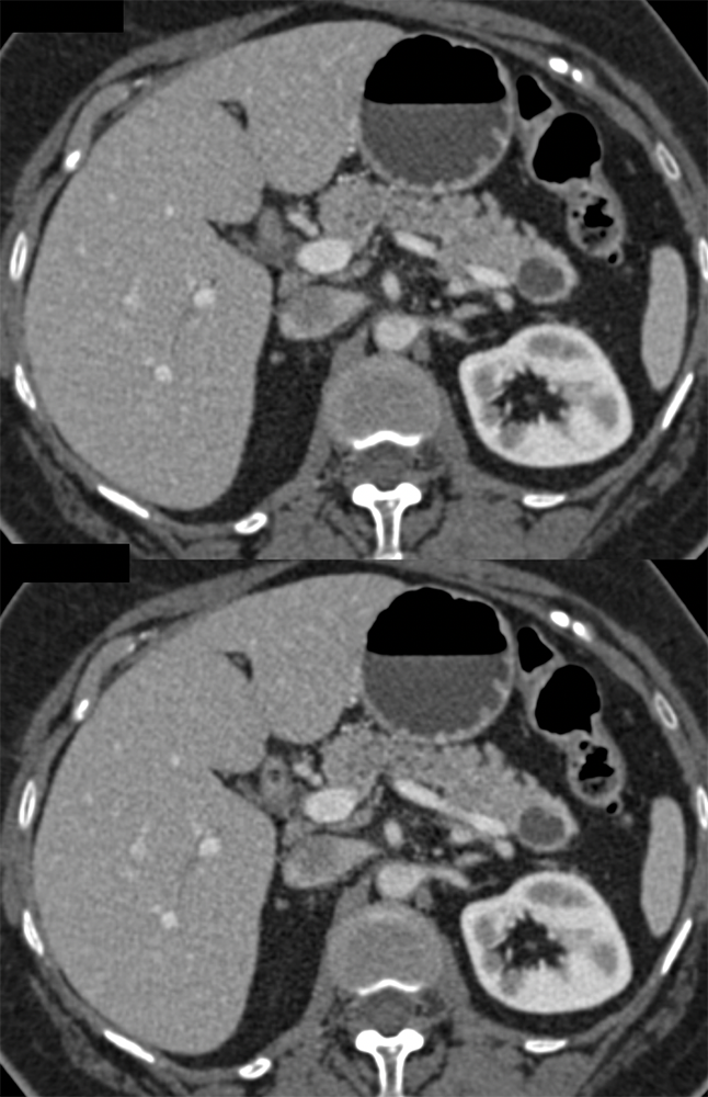 Cystic Lesion TOP: MCN with Low Grade Dysplasia