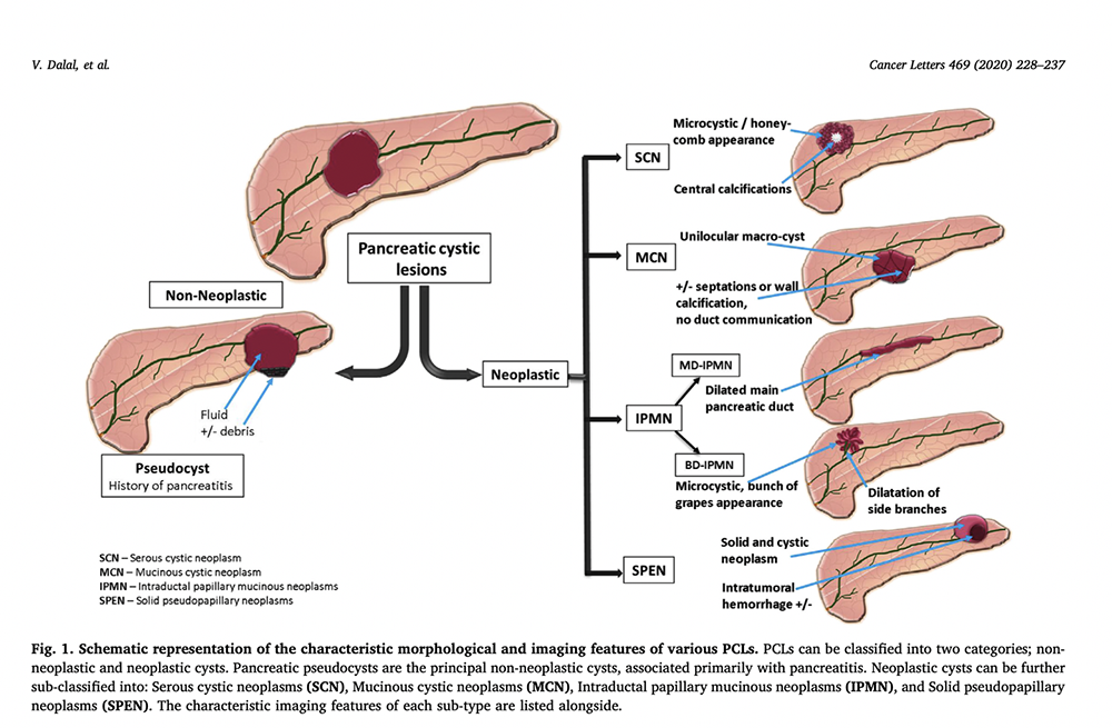 Mucinous Cystic Neoplasms