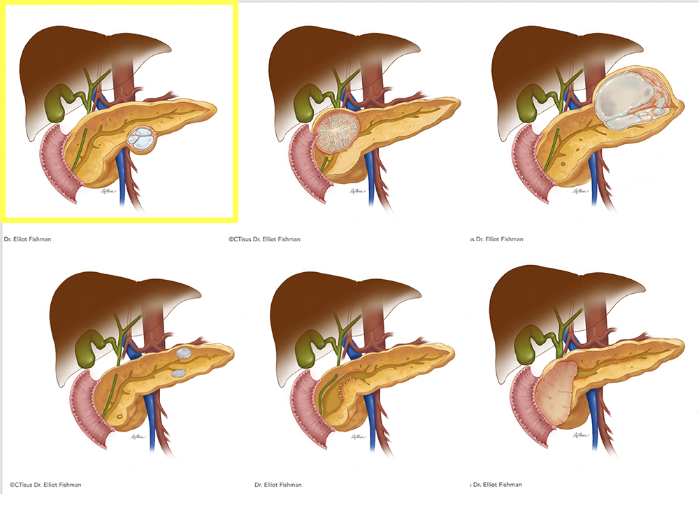 Mucinous Cystic Neoplasms