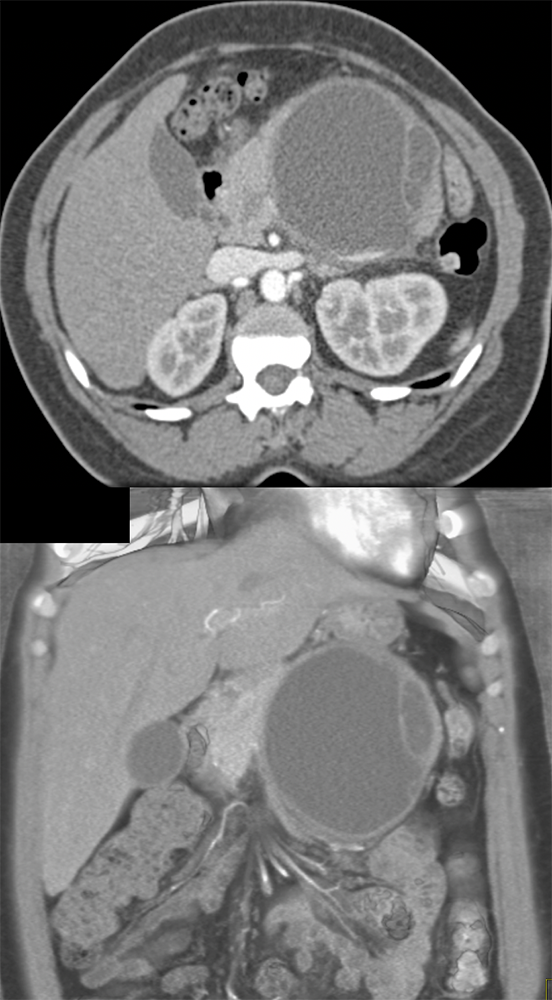 MCN with Moderate Dysplasia