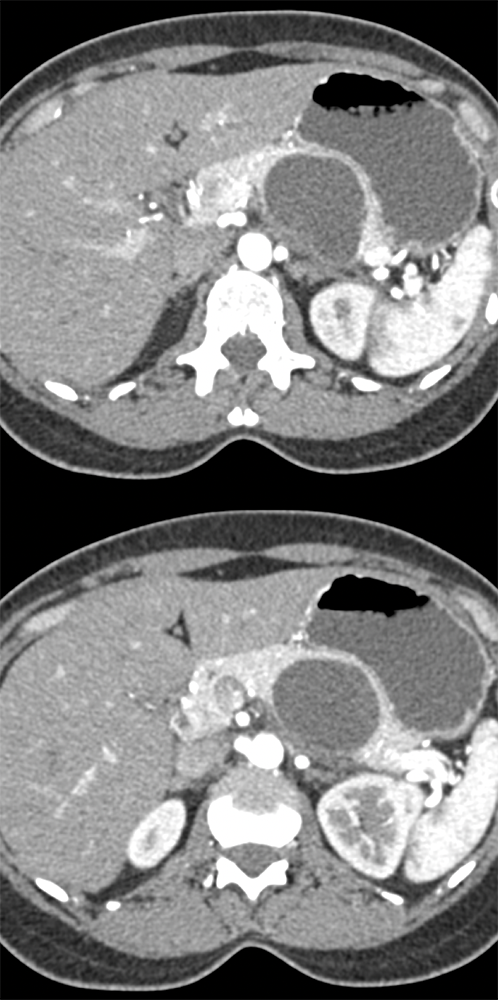 MCN Pancreas