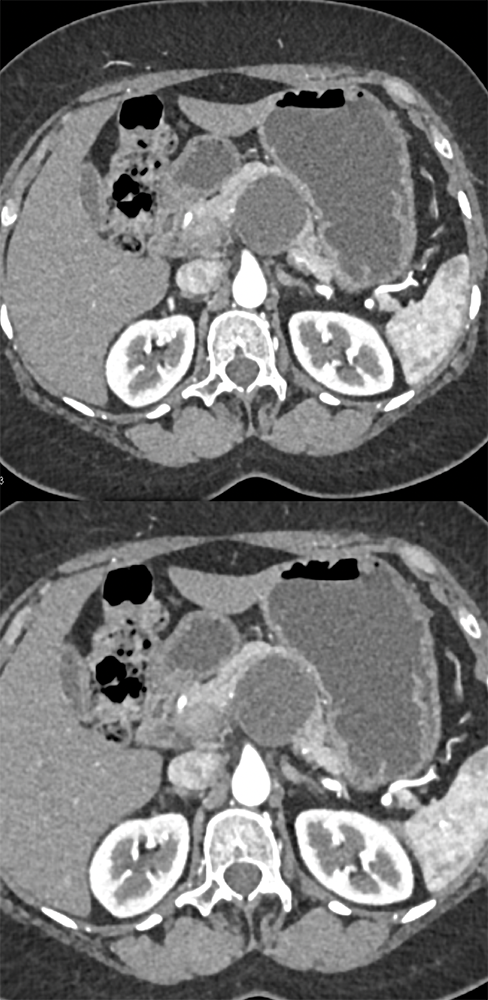 MCN with Intermediate Grade Dysplasia