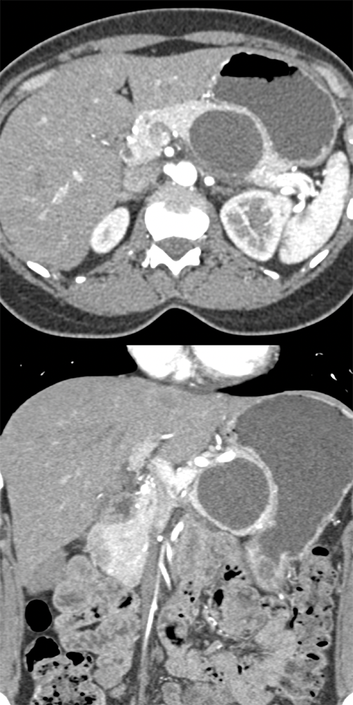 Mucinous Cystic Neoplasm