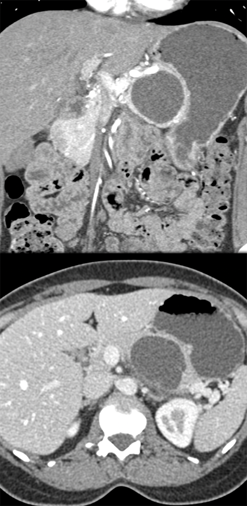 Mucinous Cystic Neoplasm