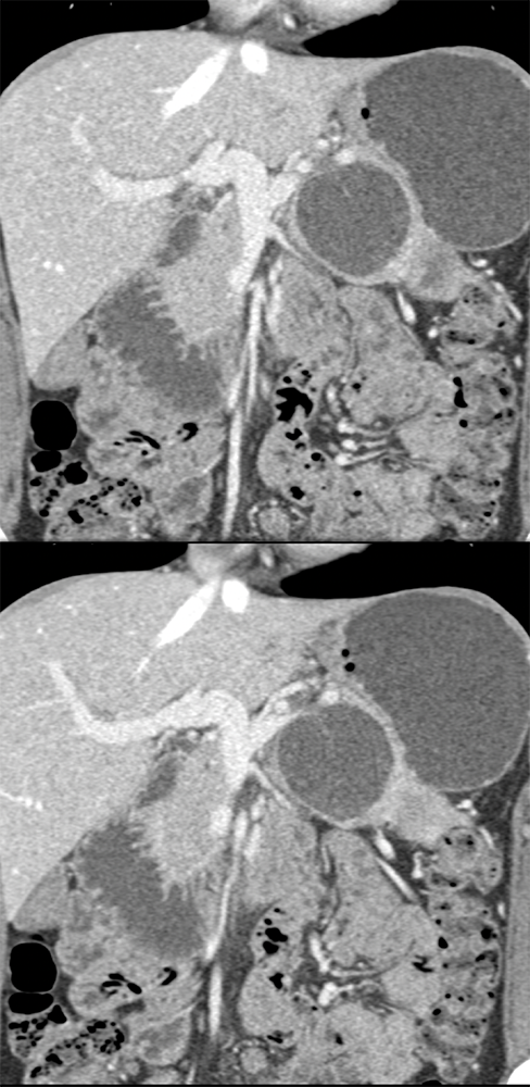 Mucinous Cystic Neoplasm