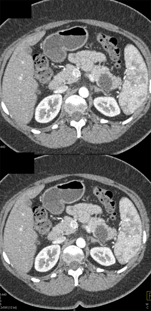 Mucinous Cystic Neoplasm (MCN)