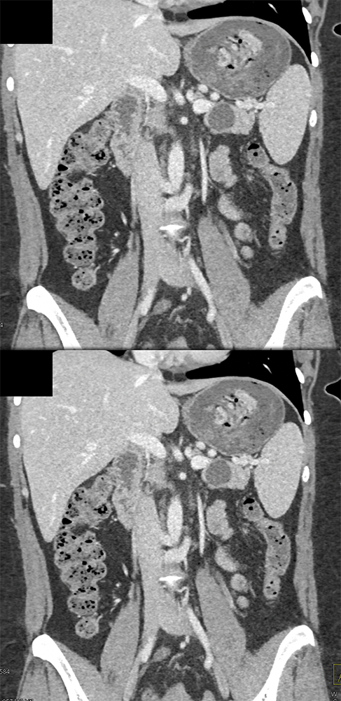 Mucinous Cystic Neoplasm